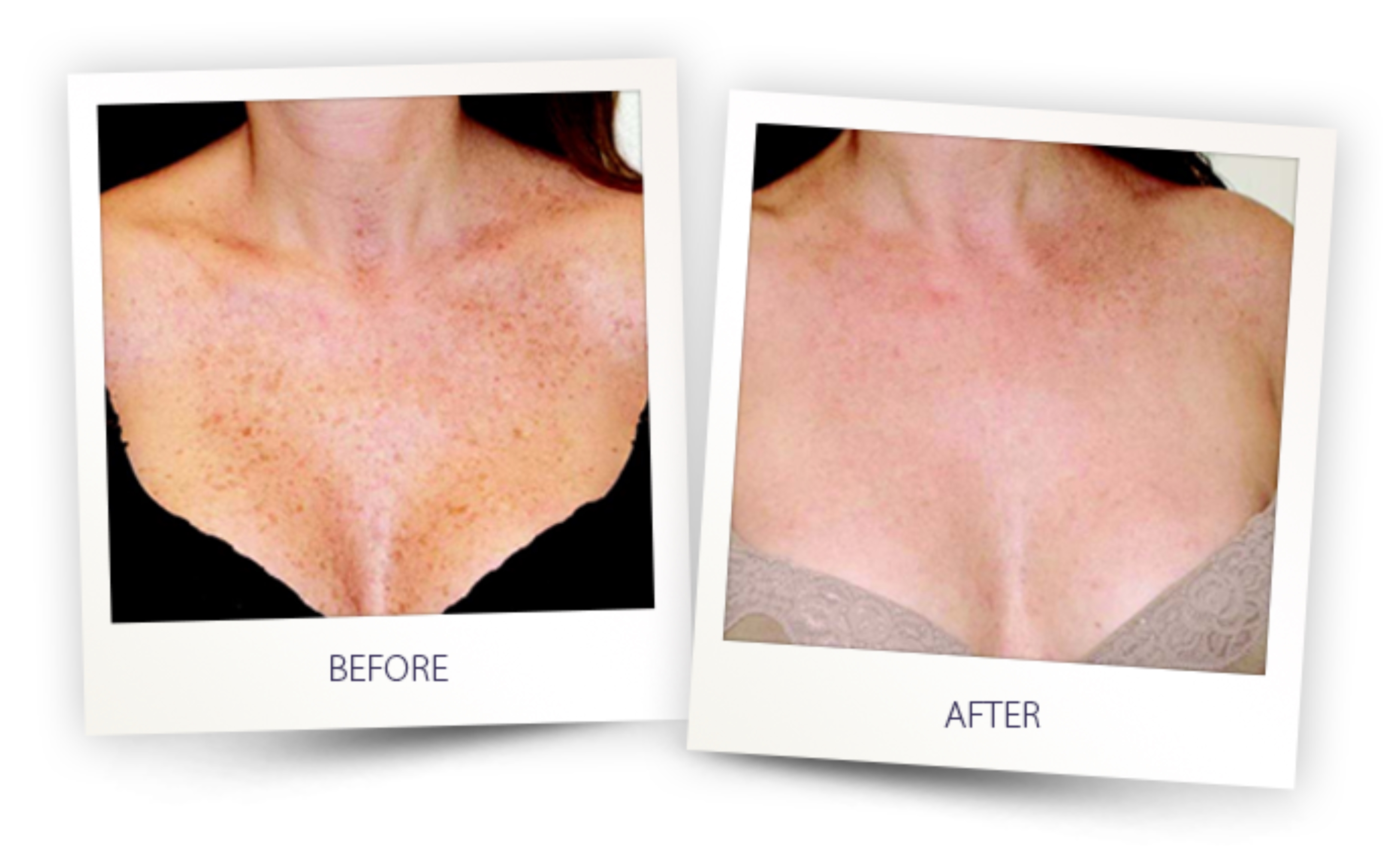 Before and after IPL treatment on décolleté — dramatic reduction in sun spots and pigmentation on chest